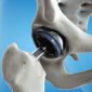 BoneImplant web_banner 85x85