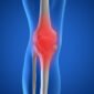 What Is Osteoarthritis 85x85