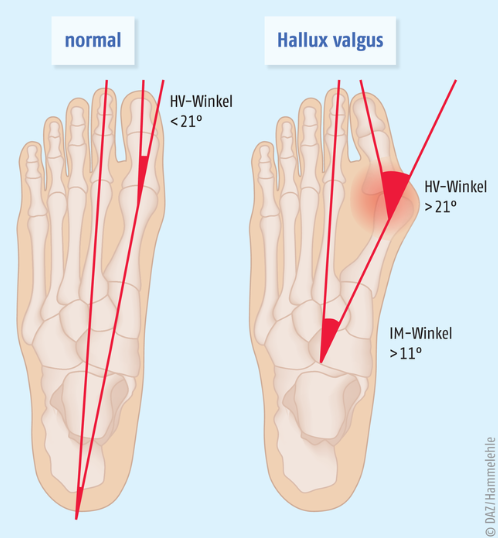 Traitements de l'Hallux Valgus (Bunion) - Options Non Chirurgicales et Chirurgicales