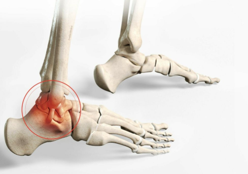 Arthroscopie de la cheville