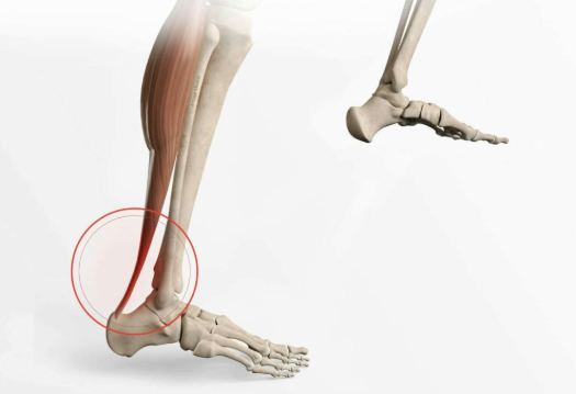Stabilisation des tendons fibulaires