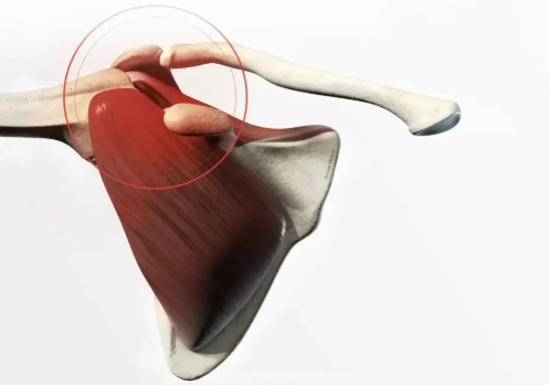Restaurer la fonction de l’épaule après déchirure