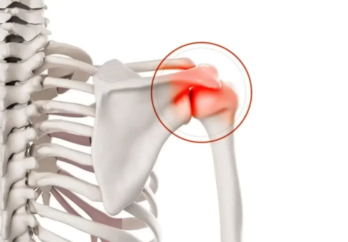 Calcification des tendons de l’épaule