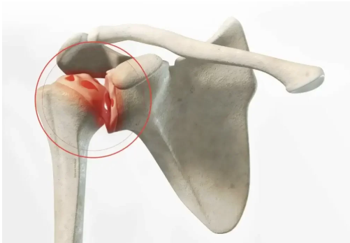 Prothèse totale de l’épaule