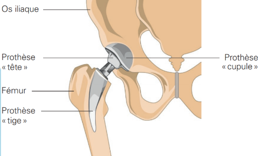 Traitement du Remplacement de la Hanche - Rétablissement et Suivi Post-Opératoire