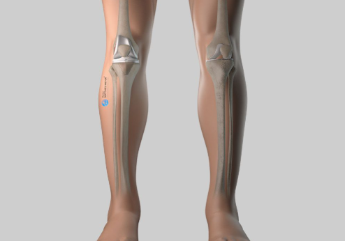 HaRécupération après le remplacement du genou