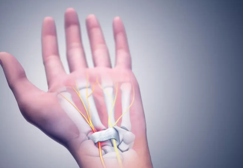Traitement du syndrome du canal carpien