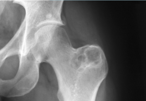 Traitement des fractures de hanche